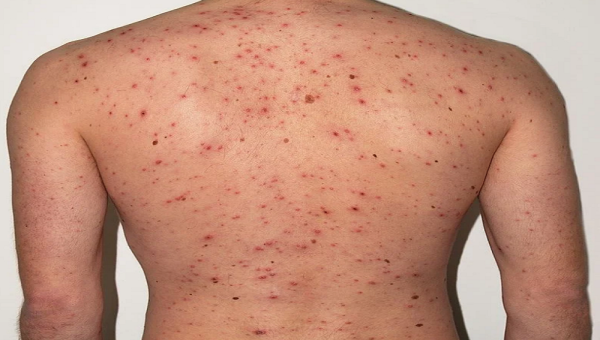 Catapora: sintomas, complicações e prevenção