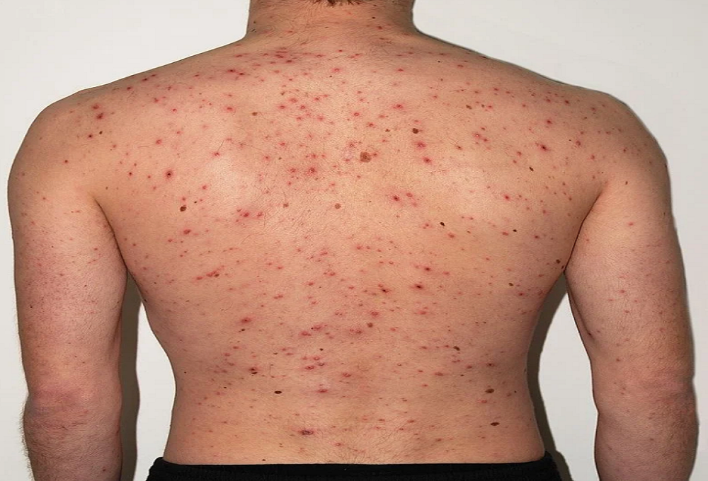 Catapora: sintomas, complicações e prevenção